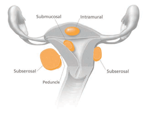 Diagram showing fibroids on the uterus